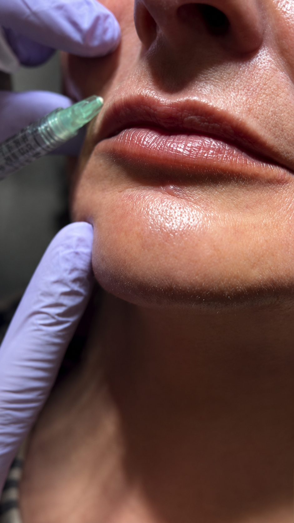 Lines & Facial Volume