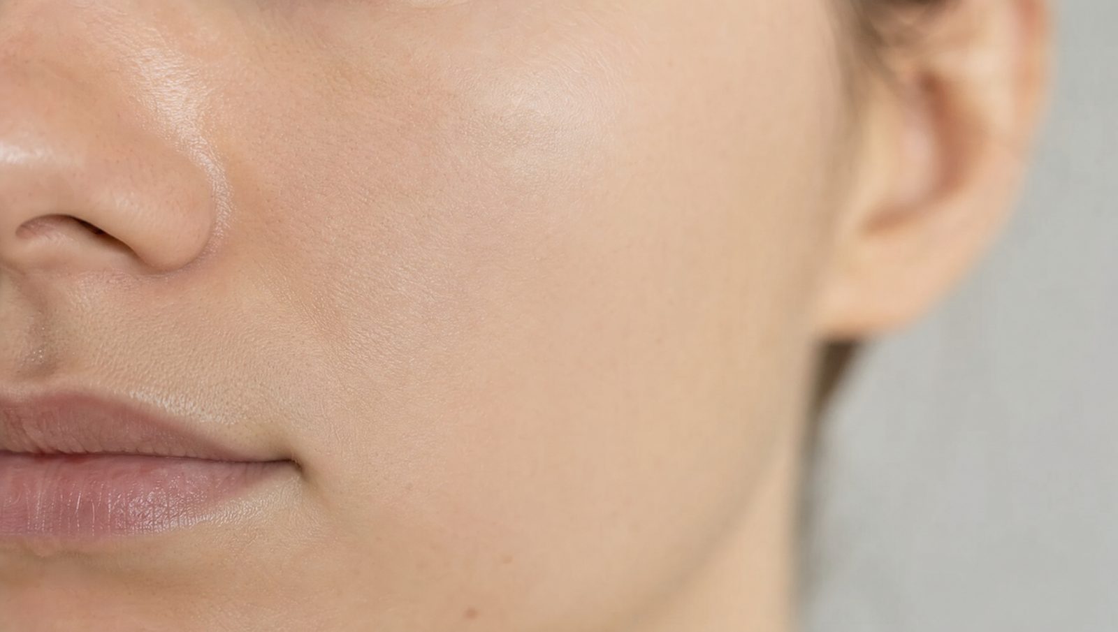 Acne