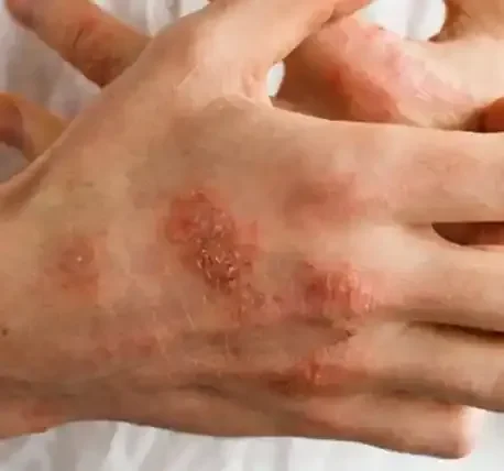 Biologic Treatments