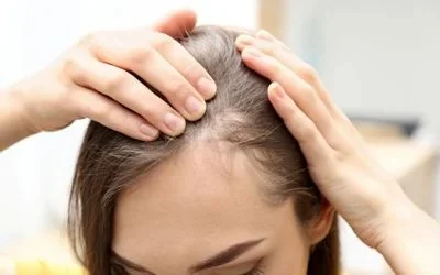 Hair Loss