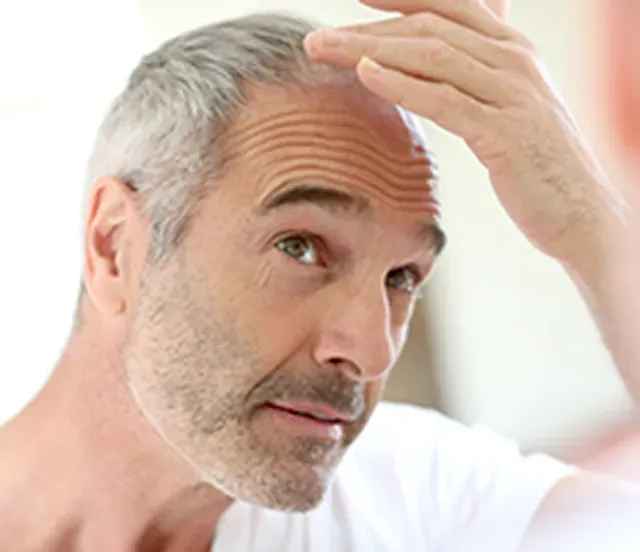 Hair Loss