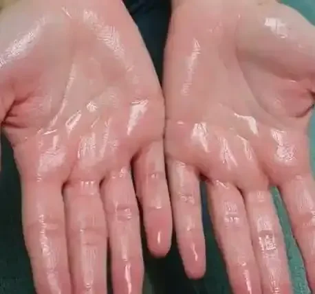 Hyperhidrosis