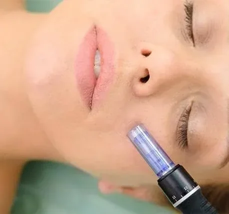 RF Microneedling