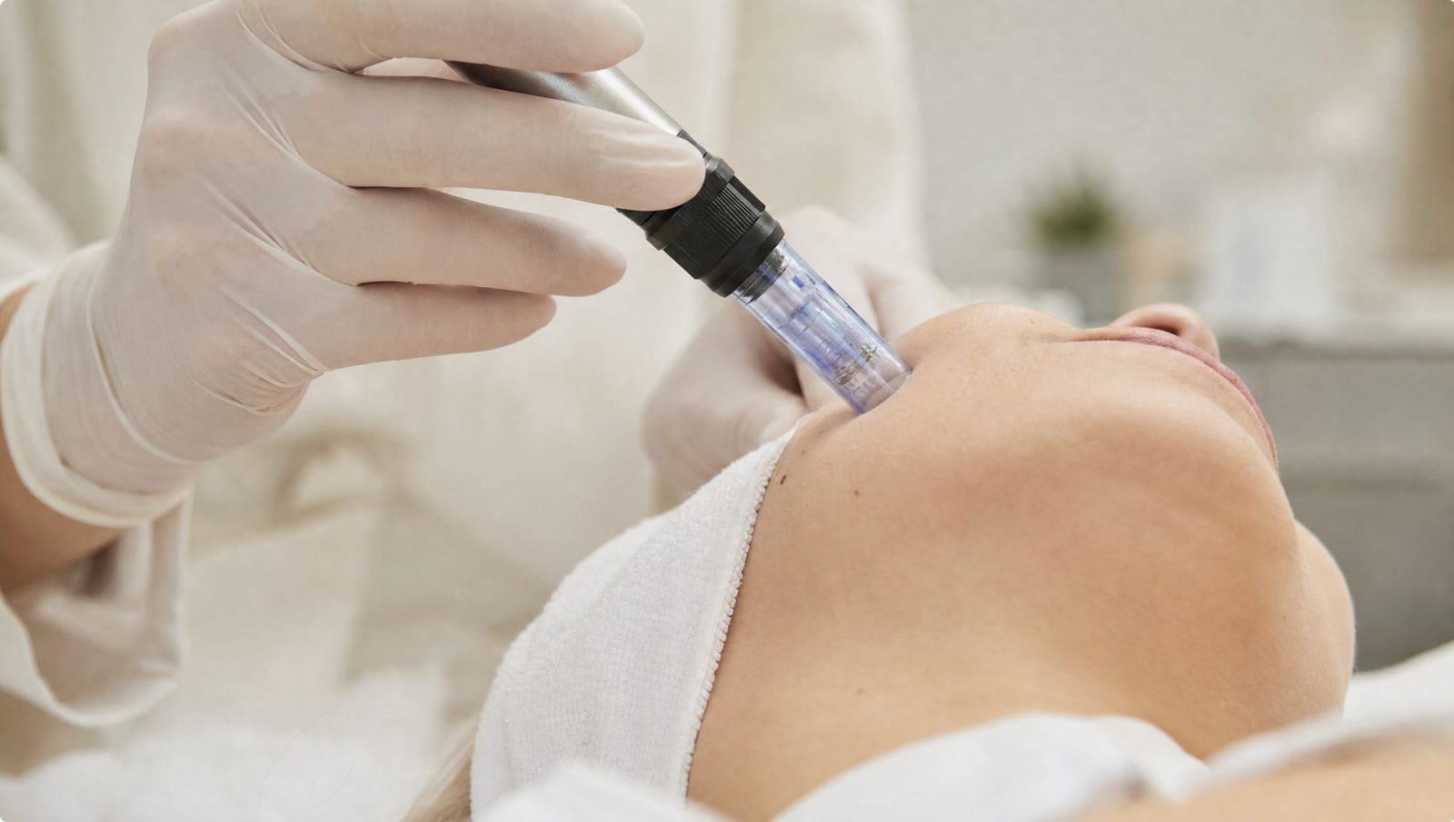PRP Microneedling
