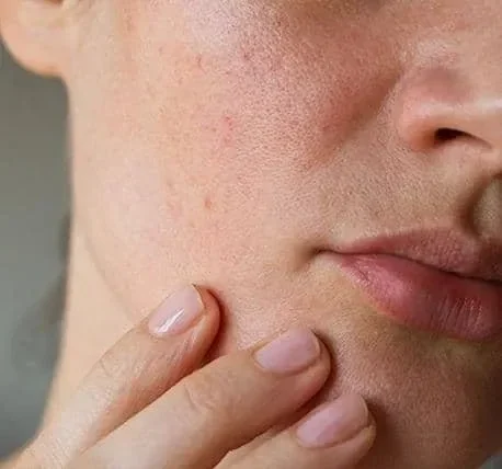Rosacea