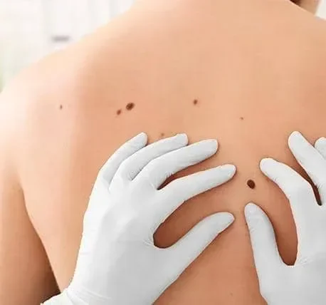 Skin Cancer