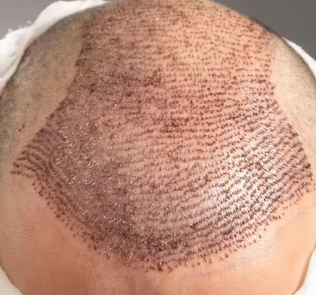 TED Hair Restoration